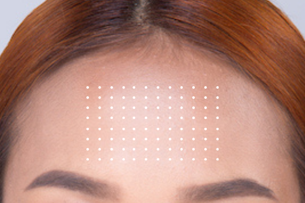 forehead-plasma-fibroblast-treatment-area