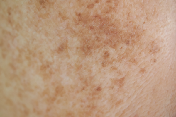 brown-spots-bbl-laser-treatment