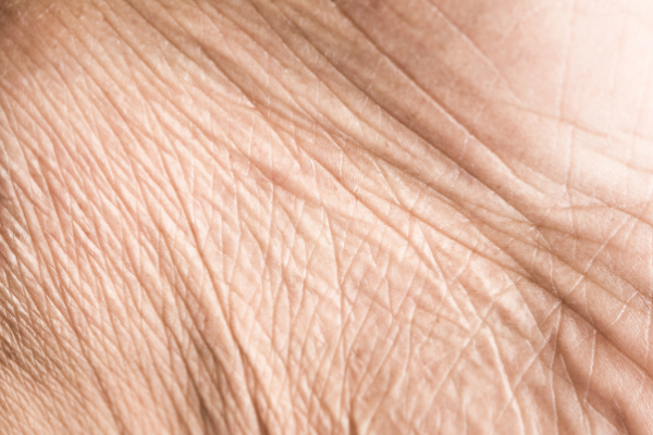 aging-skin-bbl-laser-treatment
