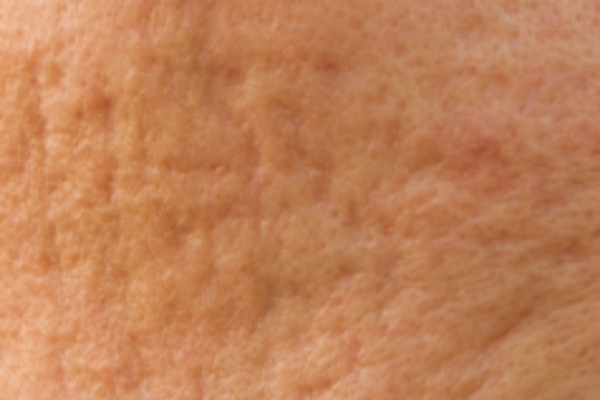 acne-scarring-halo-laser-treatment