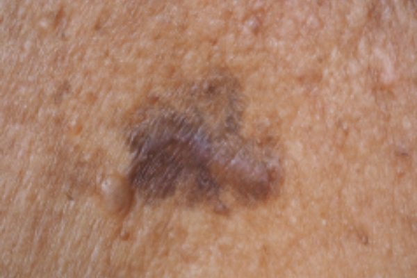 pigmented-lesions-halo-laser-treatment