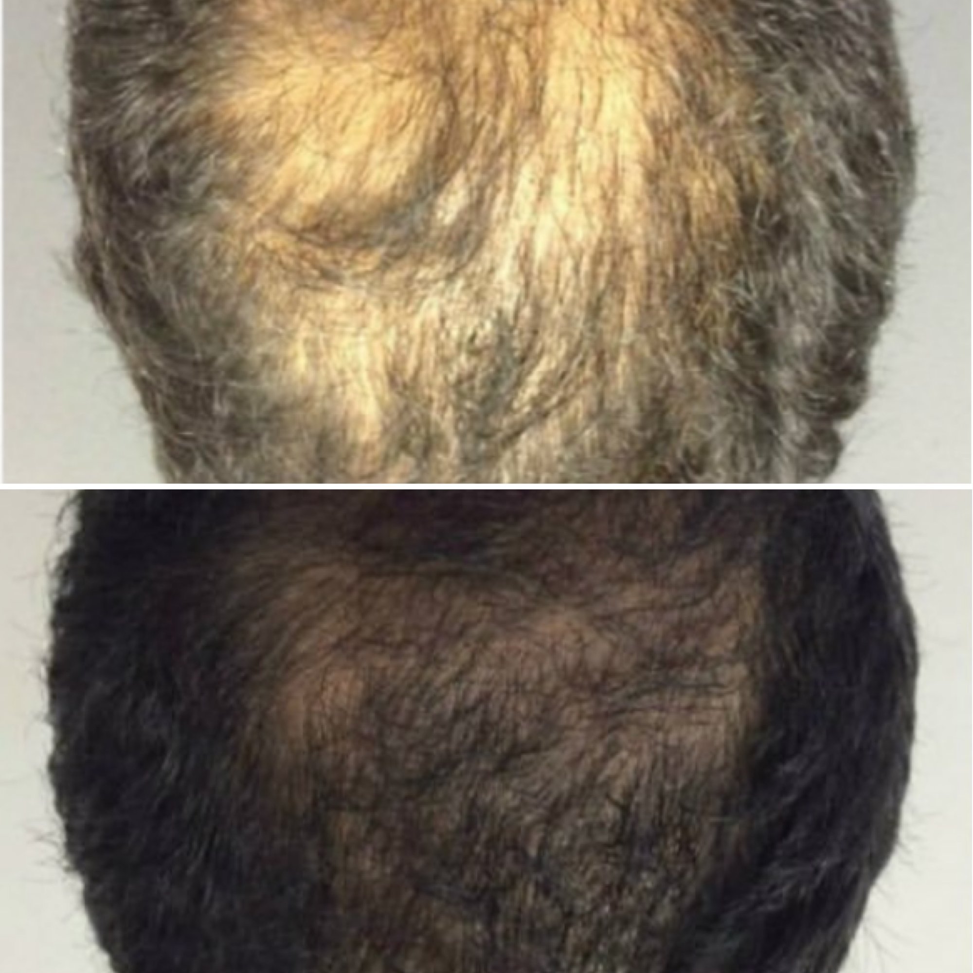 prp-hairloss10