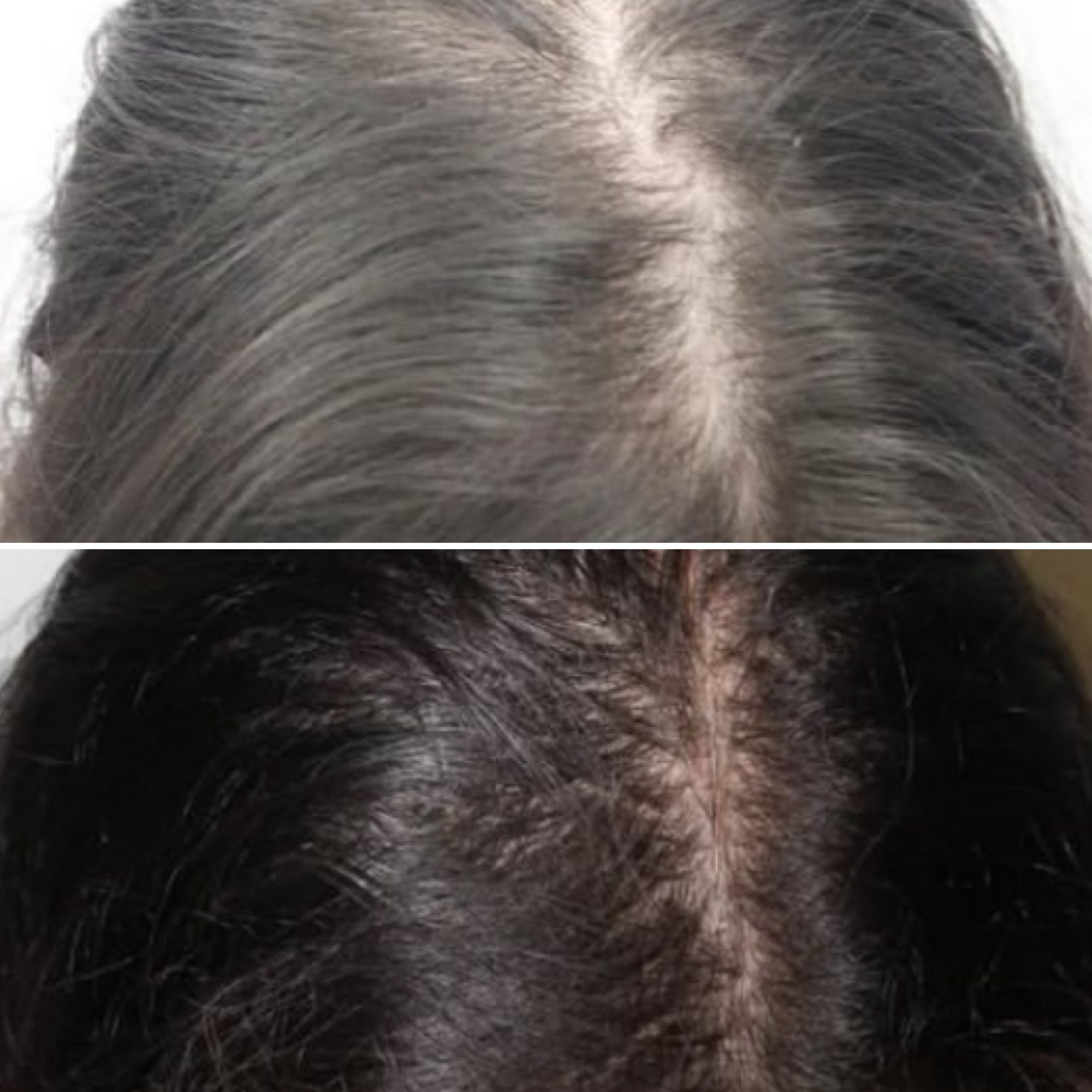 prp-hairloss9 prp-hairloss9