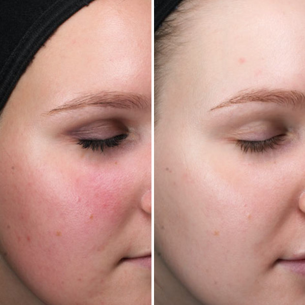 ClearSilk-BeforeAfters ClearSilk-BeforeAfters
