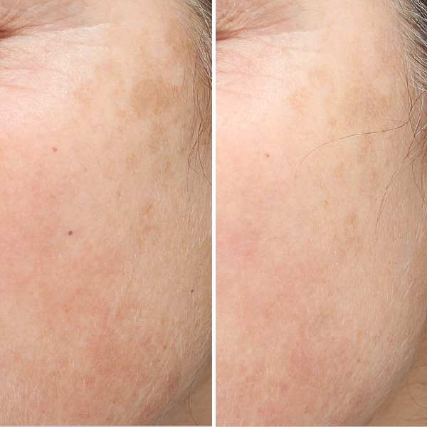 ClearSilk-BeforeAfters2 ClearSilk-BeforeAfters2