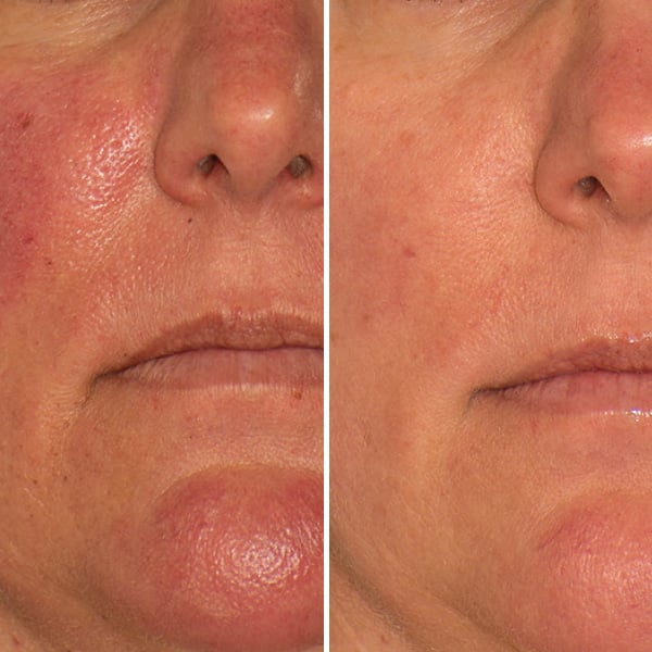 ClearSilk-BeforeAfters3 ClearSilk-BeforeAfters3