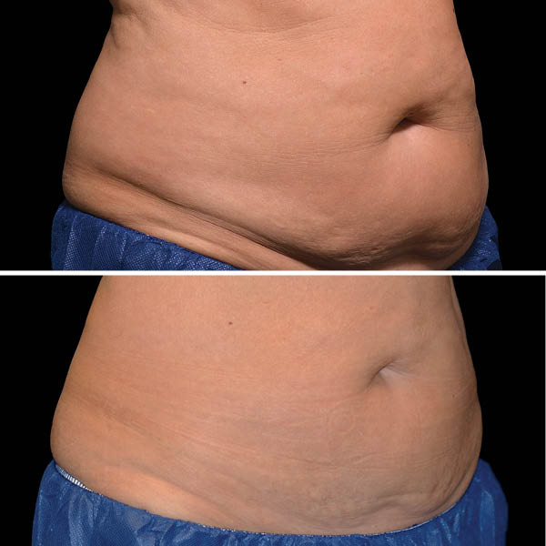 CoolSculpting-Before-After-1