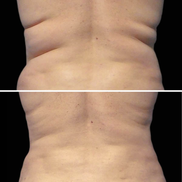CoolSculpting-Before-After-2