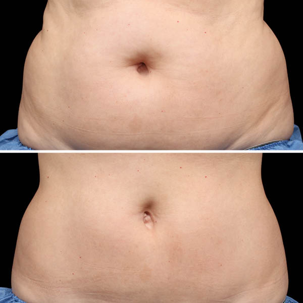 CoolSculpting-Before-After-3 CoolSculpting-Before-After-3