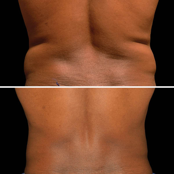 CoolSculpting-Before-After-4 CoolSculpting-Before-After-4