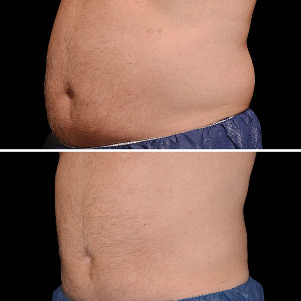 CoolSculpting-Before-After-5 CoolSculpting-Before-After-5