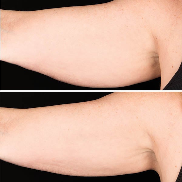 CoolSculpting-Before-After-6