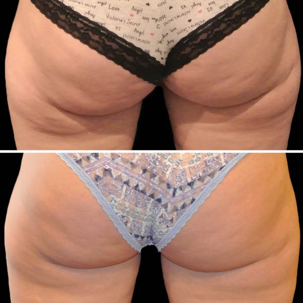 CoolSculpting-Before-After-7 CoolSculpting-Before-After-7