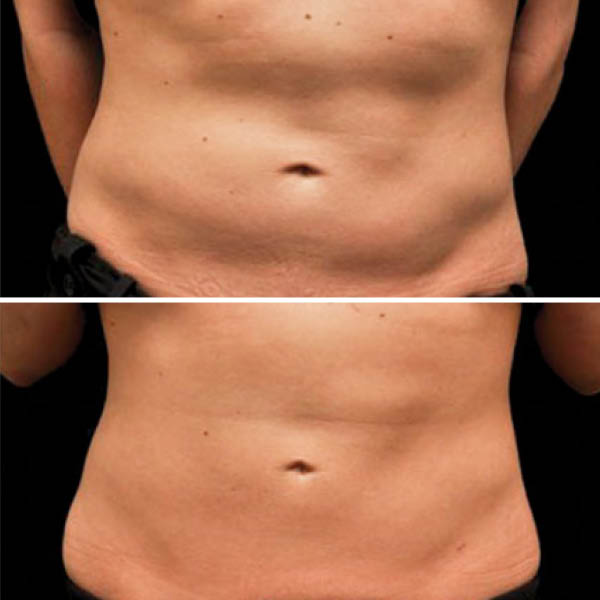 CoolSculpting-Before-After-8