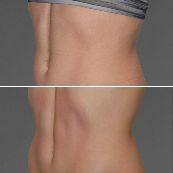 CoolTone-Before-After-1 CoolTone-Before-After-1