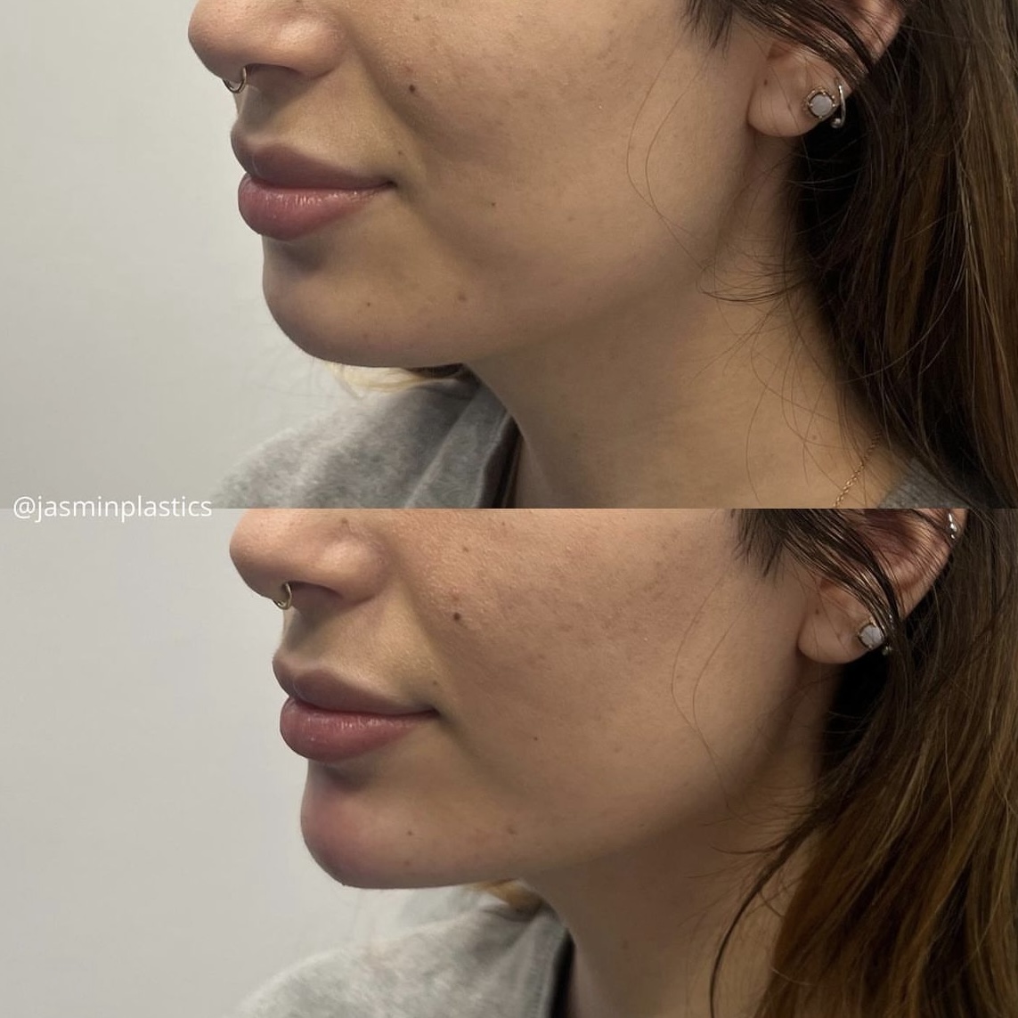 Dermal Filler Workflow_before after1 Dermal Filler Workflow_before after1