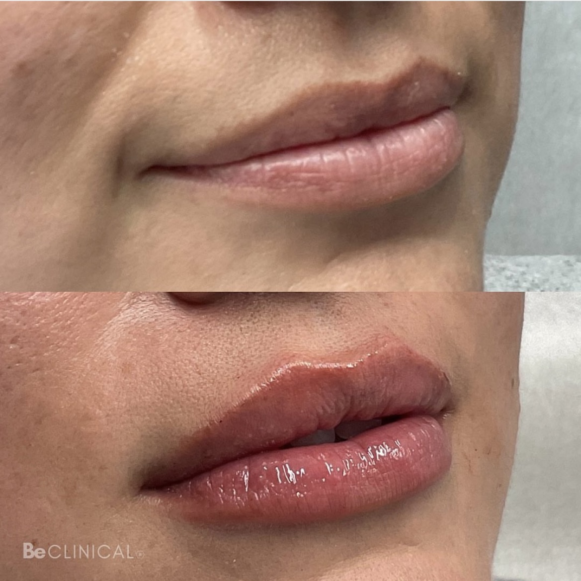 Dermal Filler Workflow_before after2