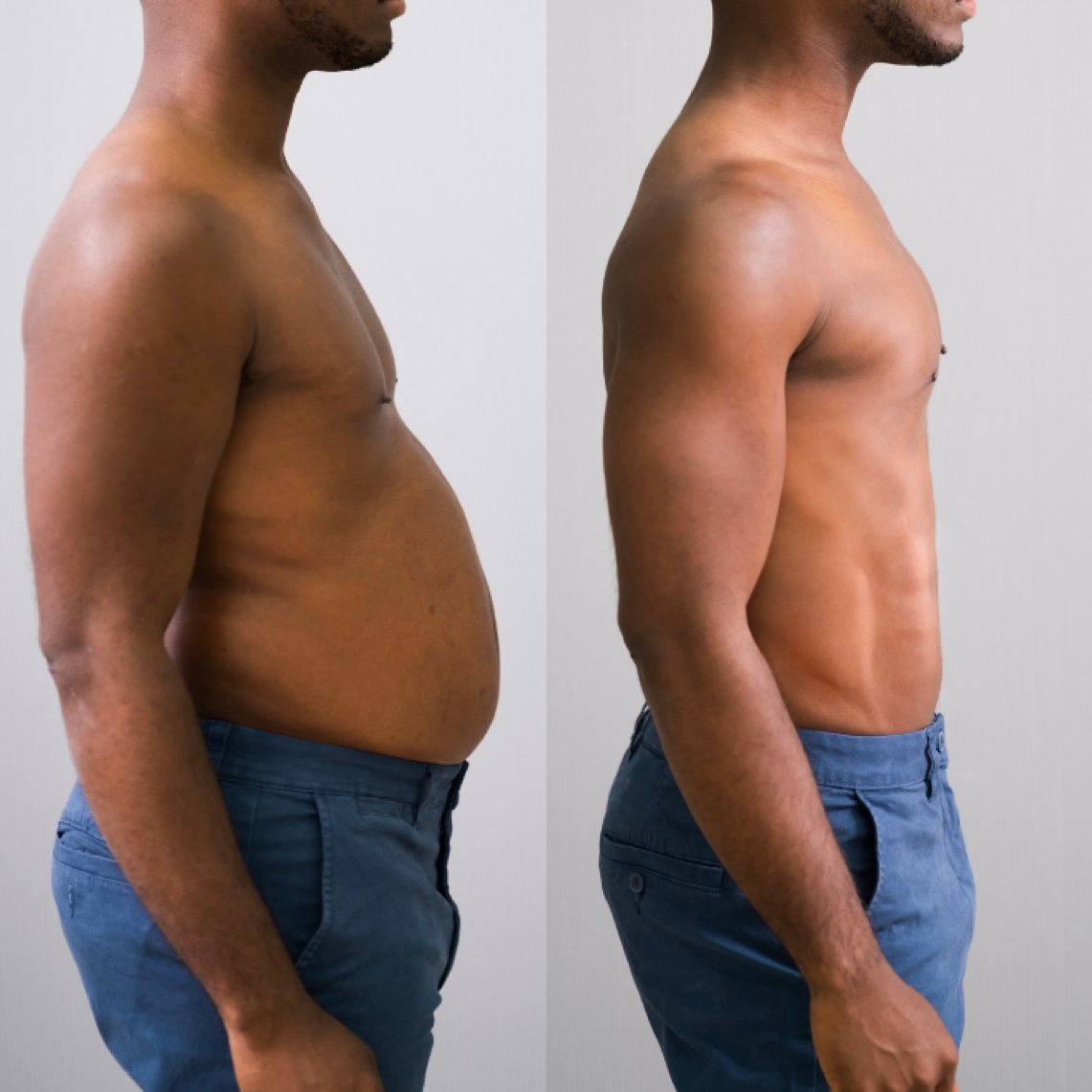 liposuction-before-and-after