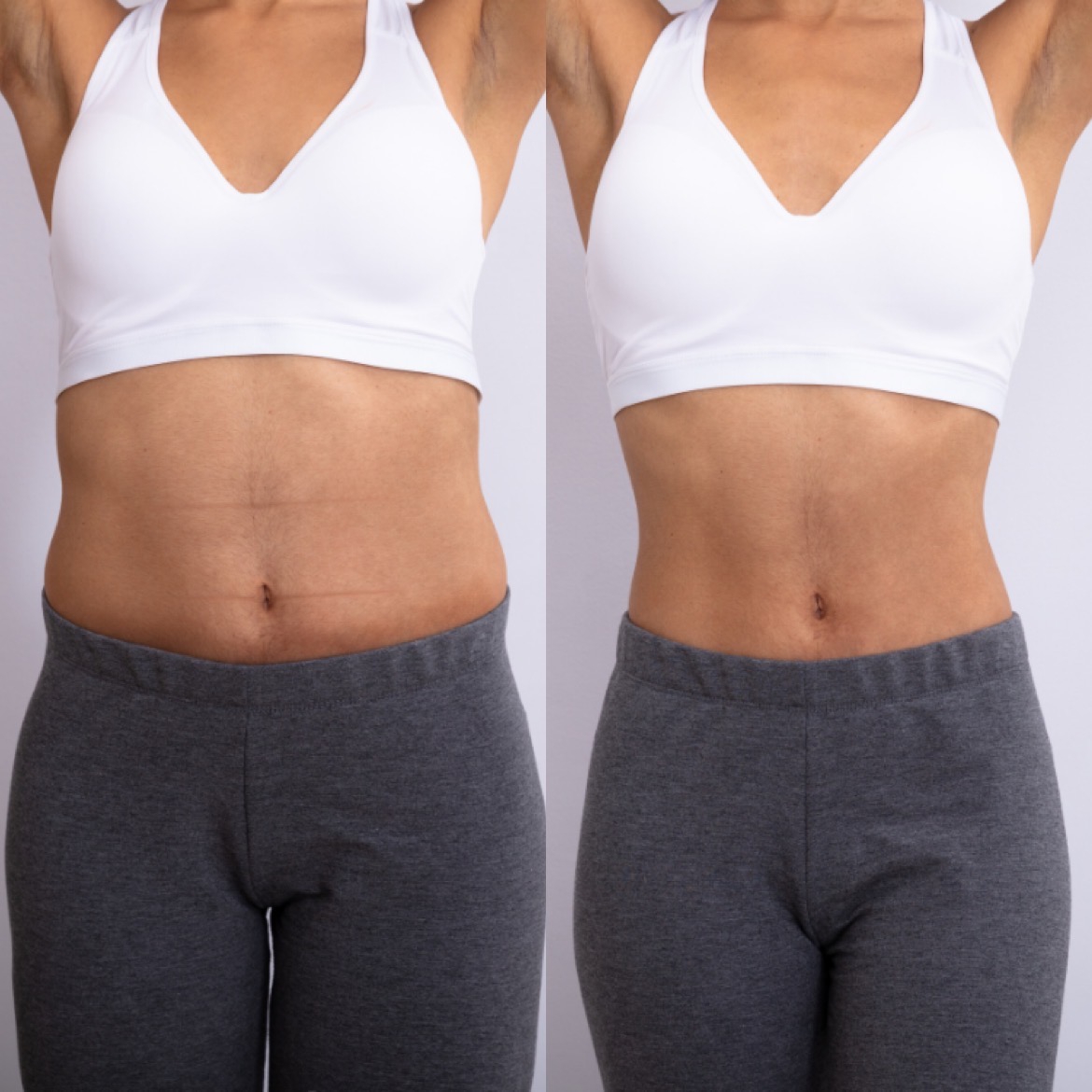 liposuction-before-and-after