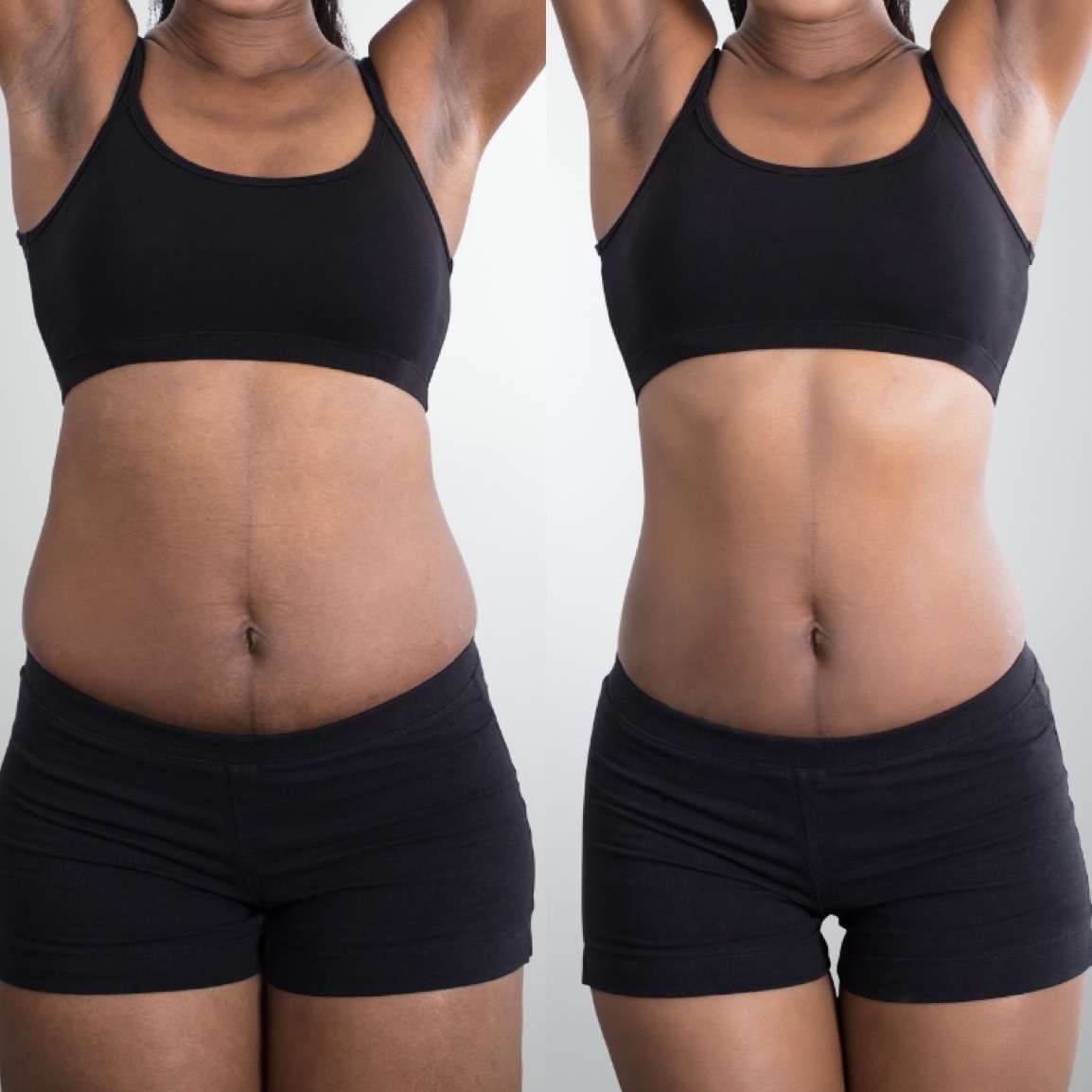 liposuction-before-and-after