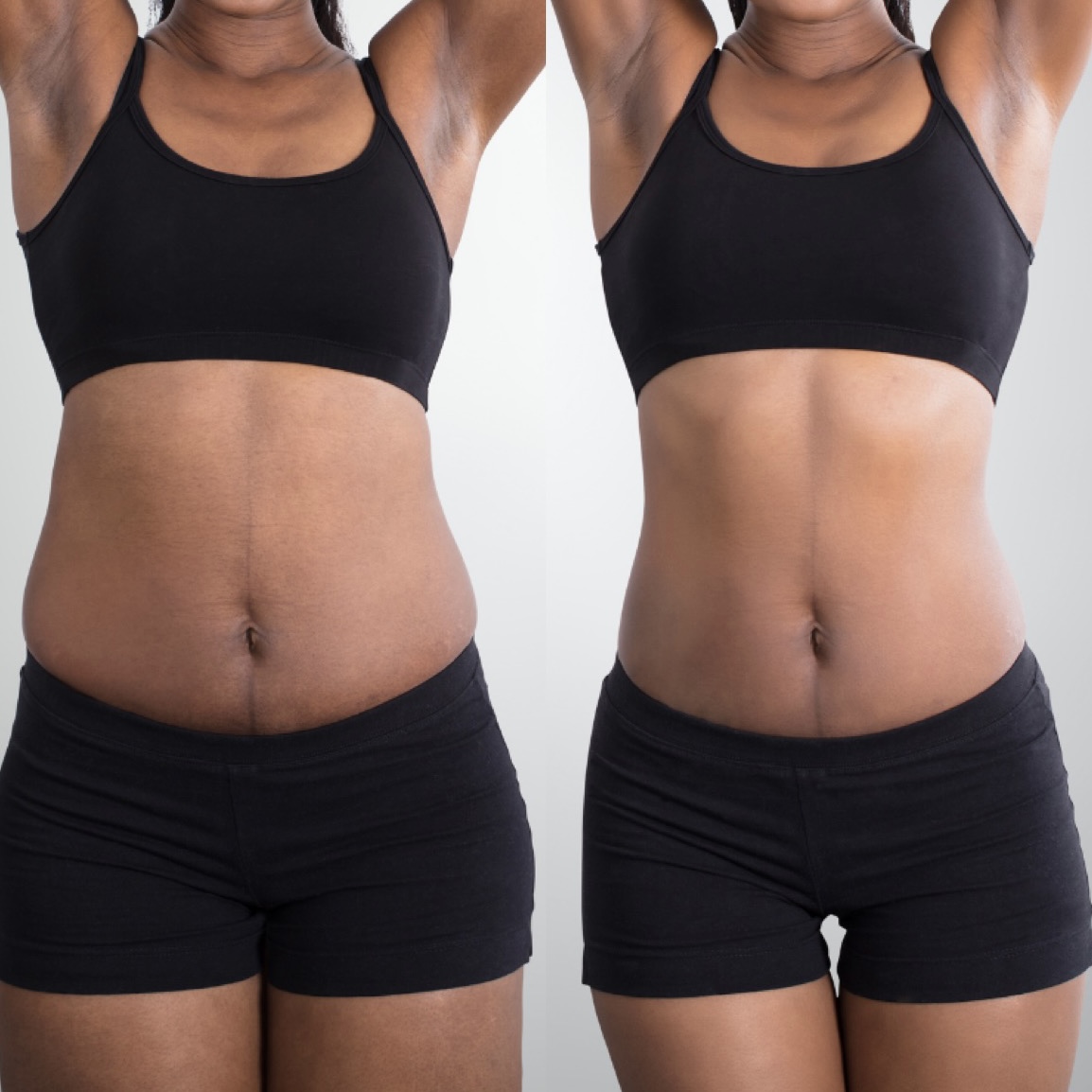 liposuction-before-and-after liposuction-before-and-after