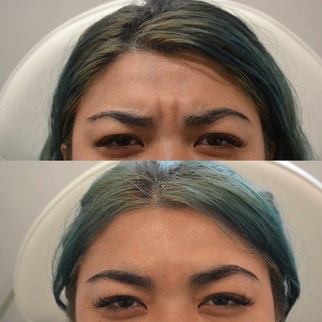 Jasmin_Botox Before After