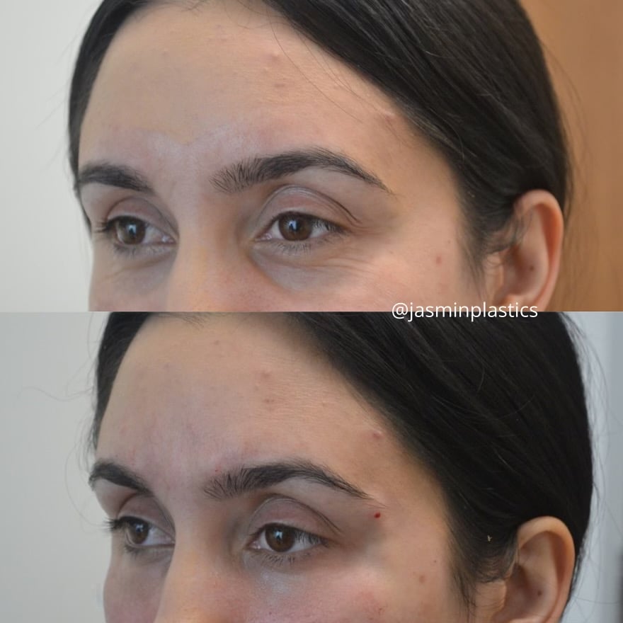 Jasmin_Tear Troughs Before After 2