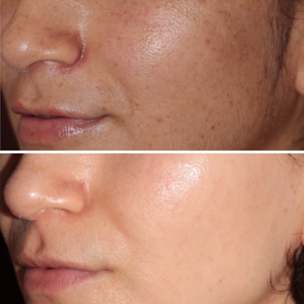 bbl-before-after-1 bbl-before-after-1