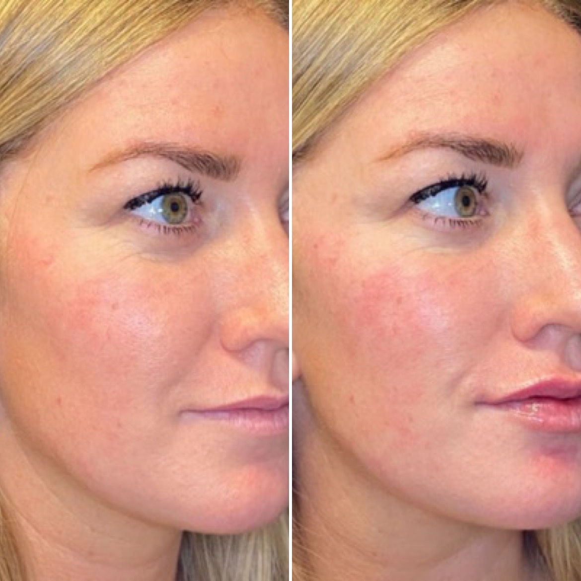 cheek filler beforeafter1 cheek filler beforeafter1