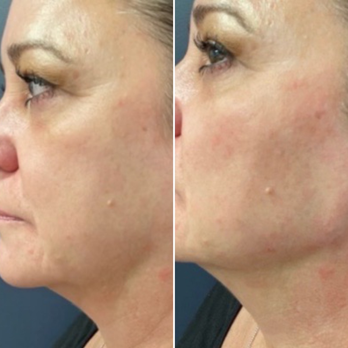 cheek filler beforeafter2 cheek filler beforeafter2