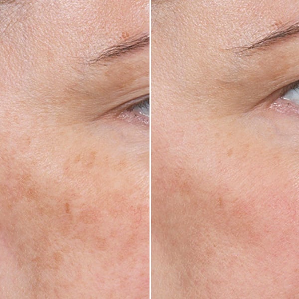 clear-and-brilliant-touch-before-after-2 clear-and-brilliant-touch-before-after-2