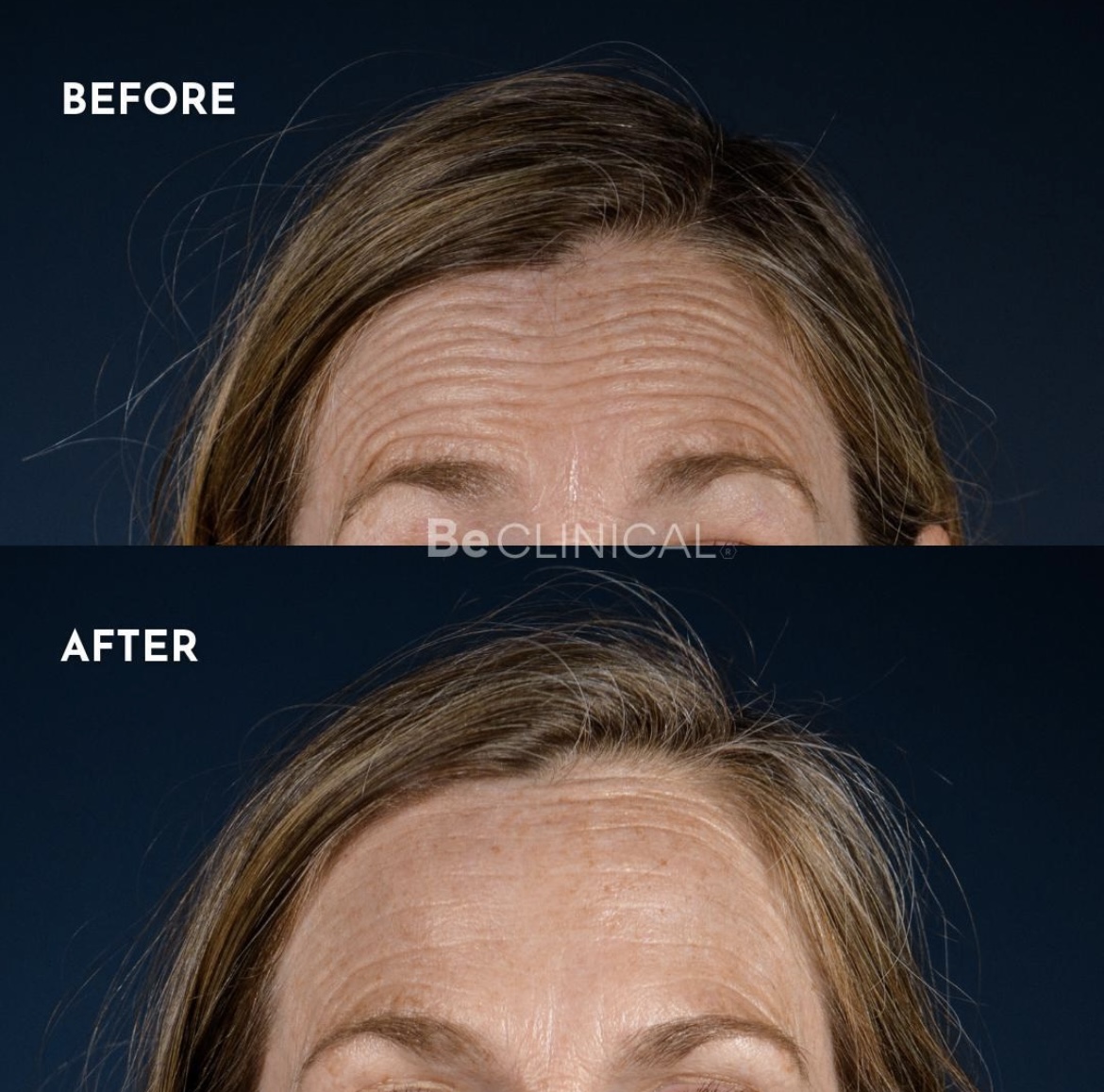 dysport-forehead-before-after-be-clinical
