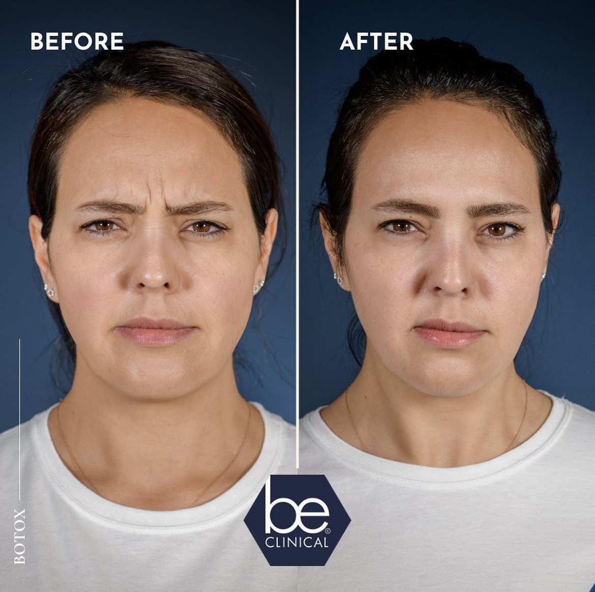dysport-frown-lines-before-after-be-clinical
