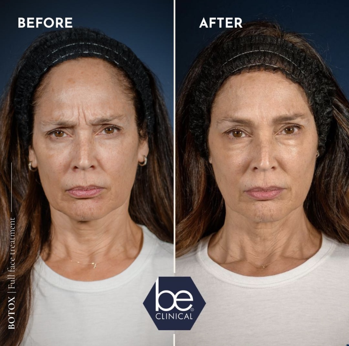 dysport-full-face-before-after-be-clinical