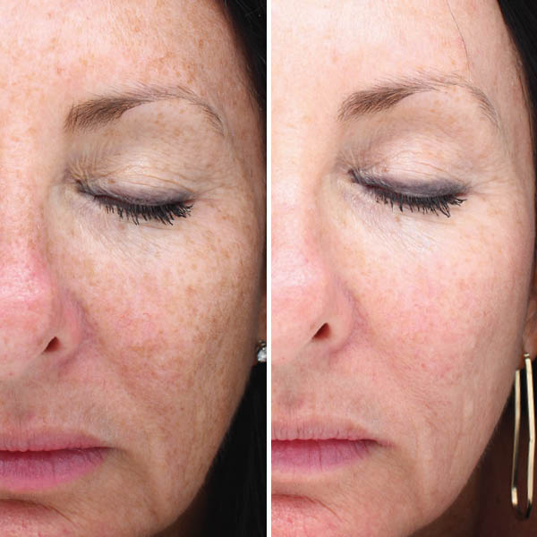 halo-before-after-1 halo-before-after-1