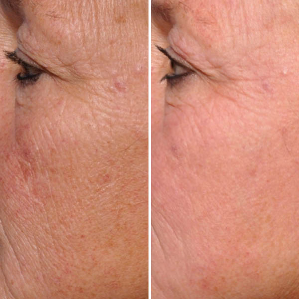 halo-before-after-5 halo-before-after-5