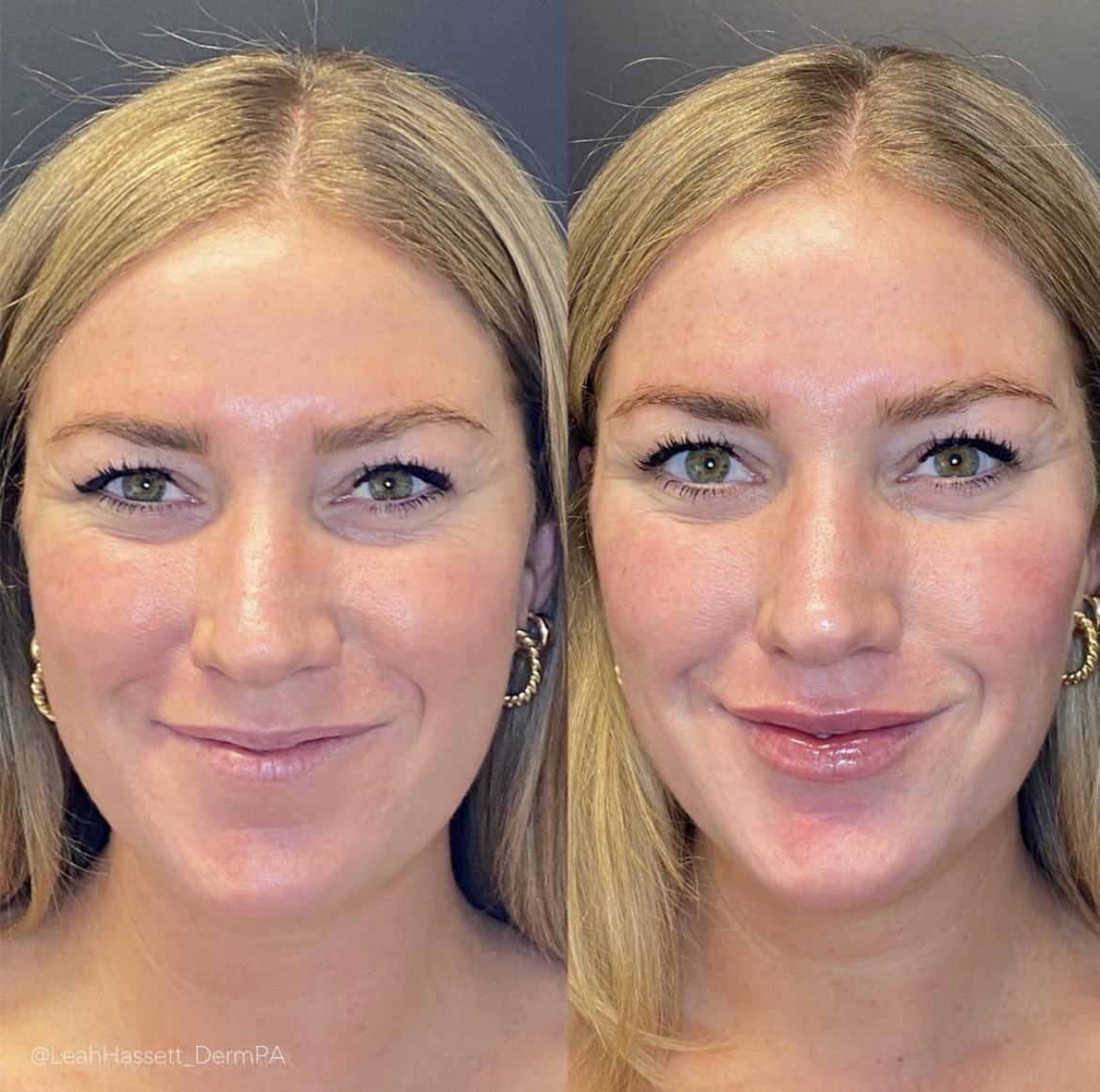 juvederm-cheek-filler-lip-filler-before-after-be-clinical