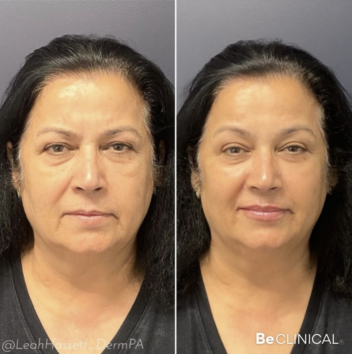 juvederm-full-face-filler-before-after-be-clinical