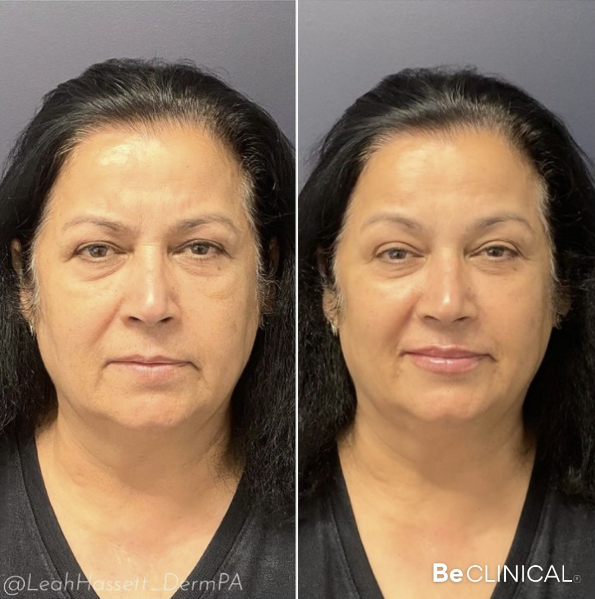 juvederm-full-face-filler-before-after-be-clinical juvederm-full-face-filler-before-after-be-clinical