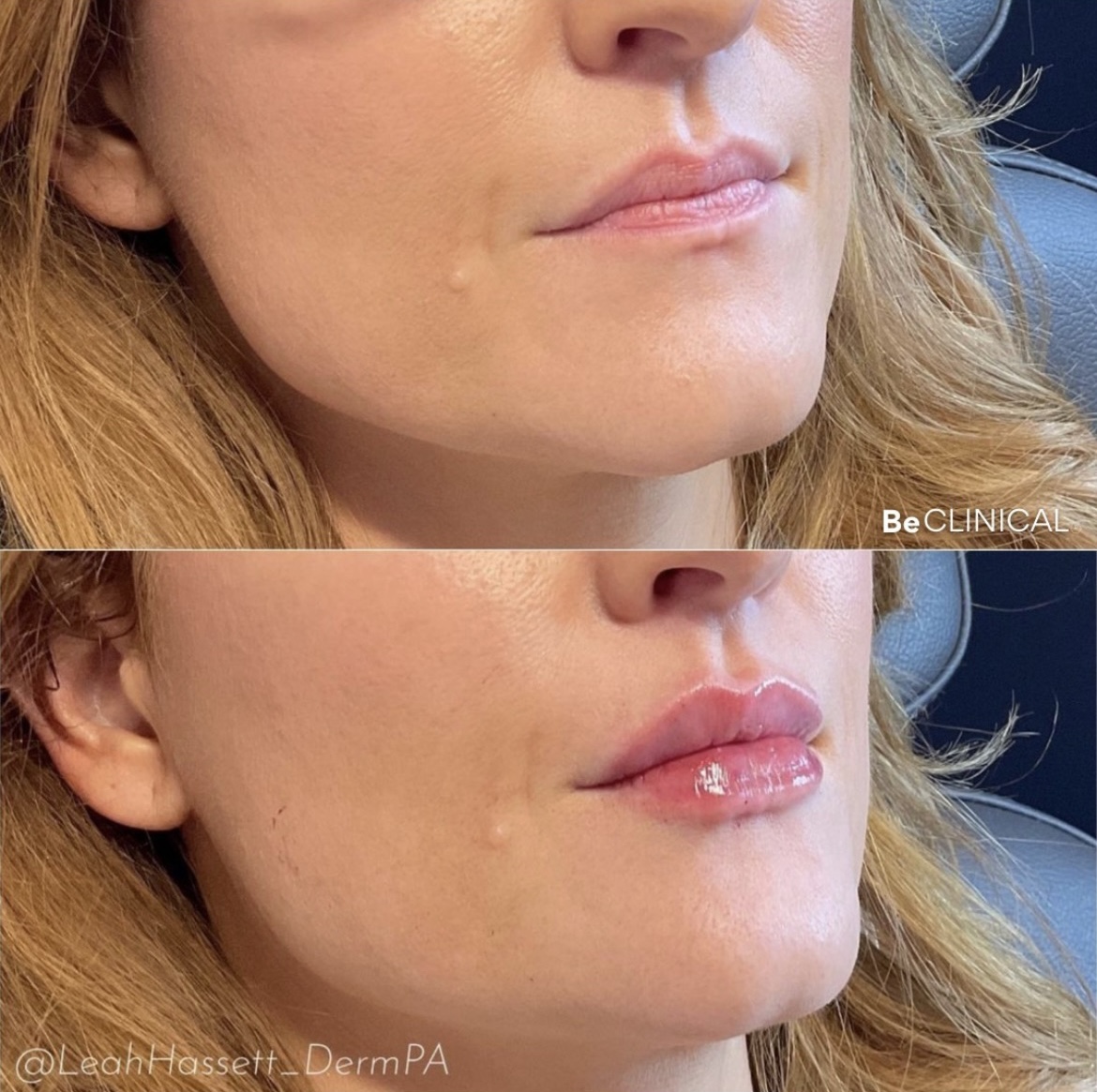 lip injections near me book online