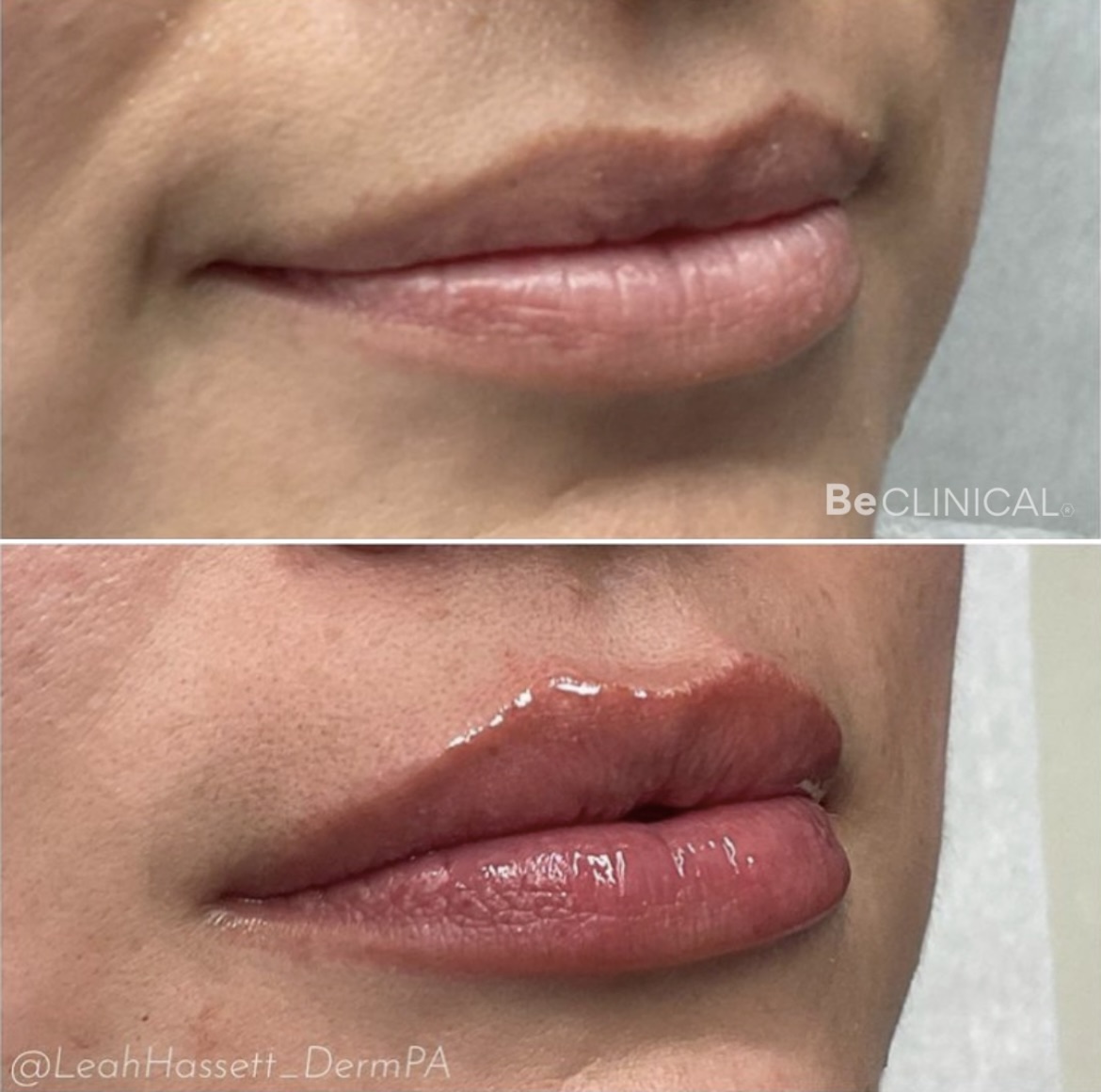 juvederm-lip-filler-before-after