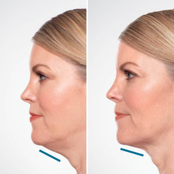 kybella-before-after-2