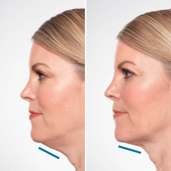 kybella-before-after-2 kybella-before-after-2