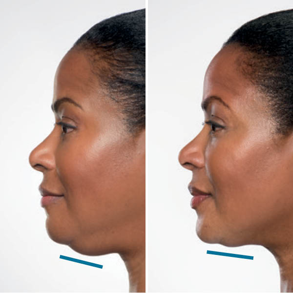 kybella-before-after-4 kybella-before-after-4