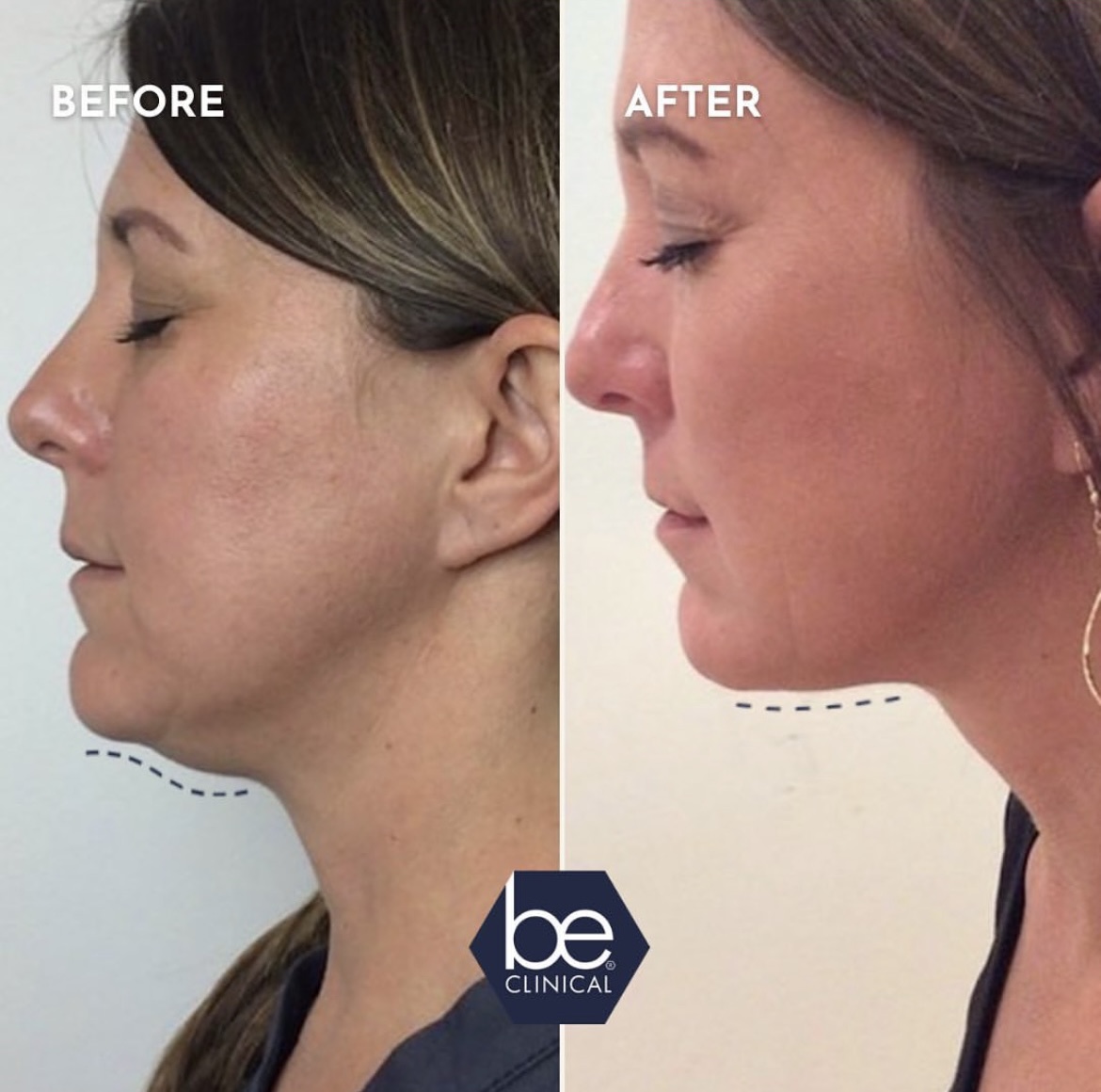 kybella-before-after-be-clinical kybella-before-after-be-clinical