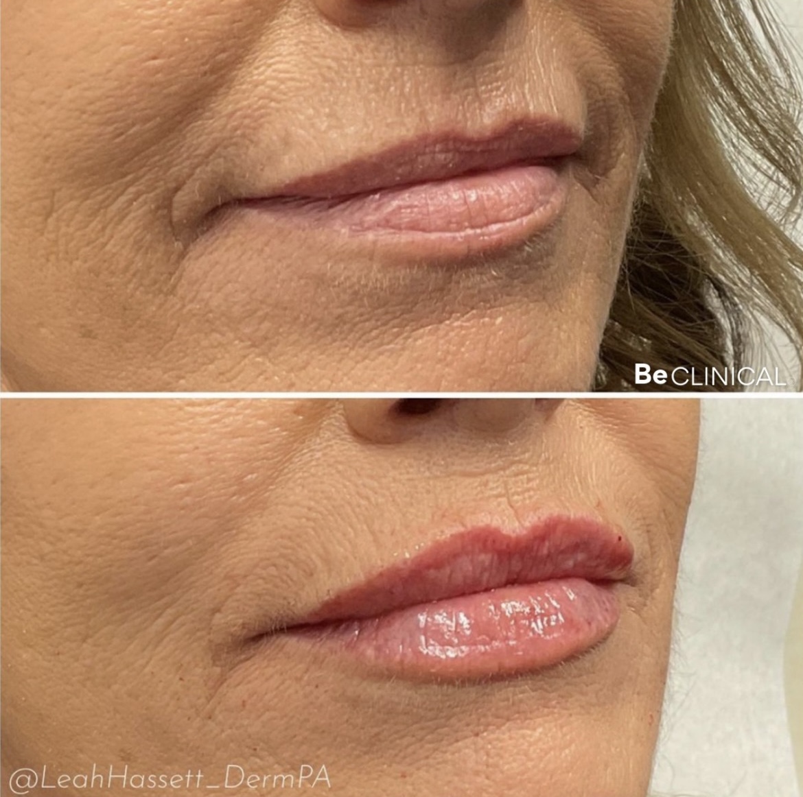 lip-filler-before-after-be-clinical-2