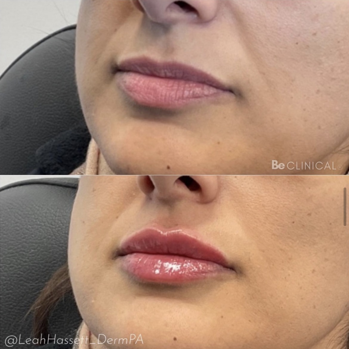 lip-filler-before-after-be-clinical-3 lip-filler-before-after-be-clinical-3