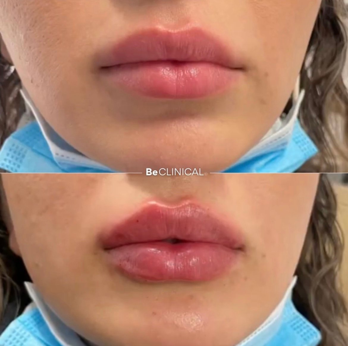 lip-filler-before-after-be-clinical