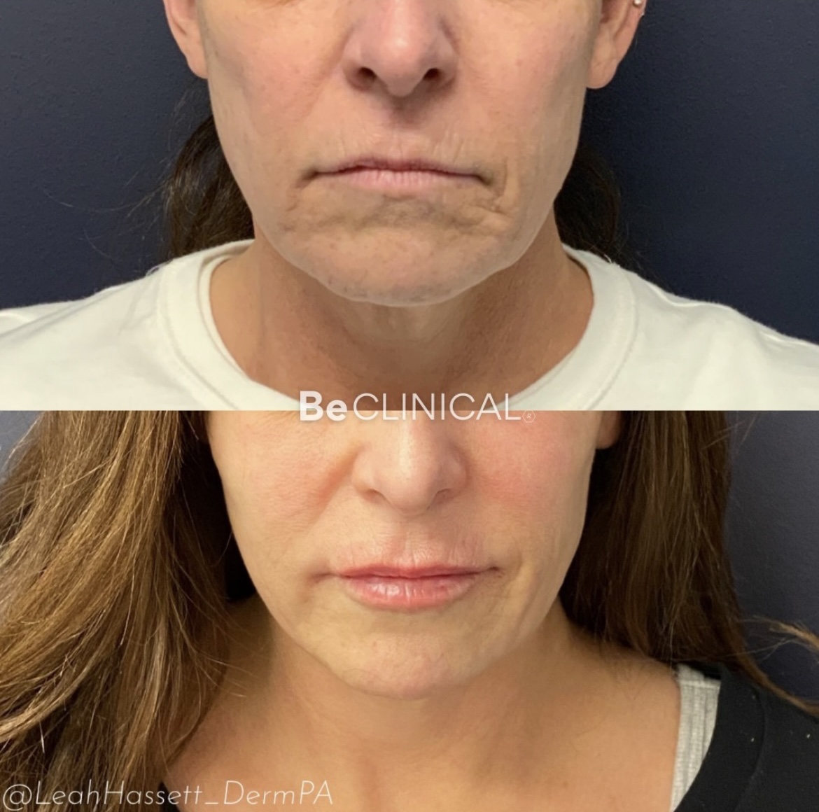 lower-face-filler-be-clinical