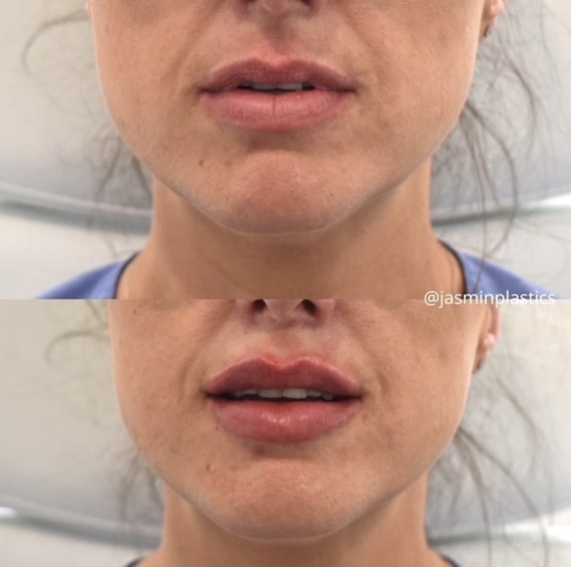 restylane-kysse-lip-filler-before-after